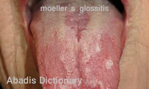 moellerˈs glossitis